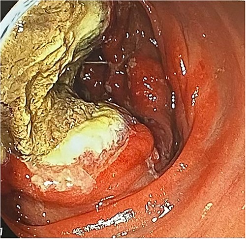 Colonoscopy revealed a mass lesion with ulcerative changes.