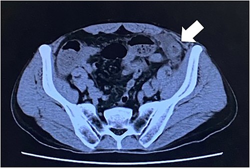 The white arrow shows the site of caliber change in the small bowel (axial section image).