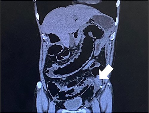 The white arrow shows the small bowel incarcerating into the preperitoneal space (coronal section image).