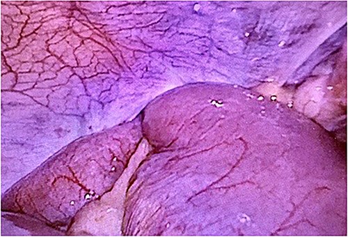 The closed peritoneum was lacerated, and the small bowel was incarcerated in the preperitoneal space.