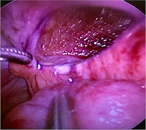 The lacerated peritoneal hole formed a hernia orifice.