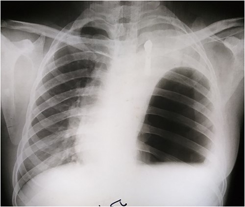 Presurgical CXR.