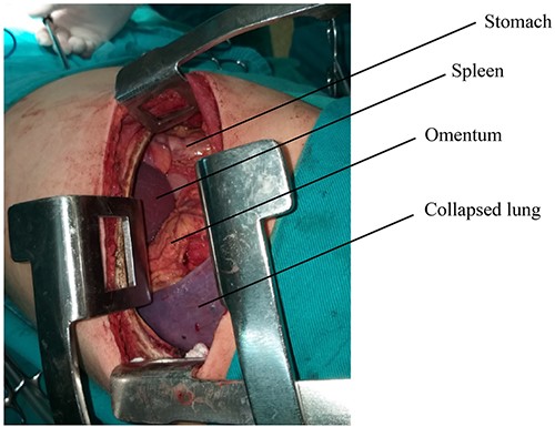 Abdominal viscera during the surgery.