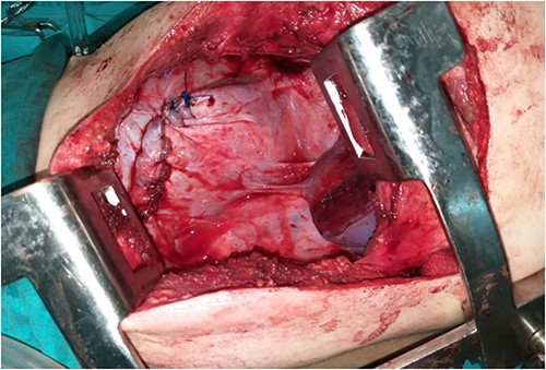 Diaphragm after repair.
