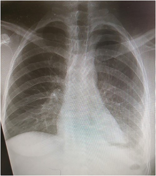 CXR postsurgery.