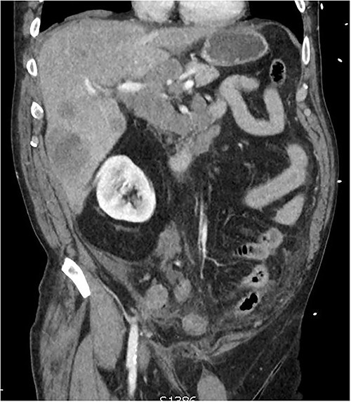 CT of the abdomen from admission demonstrating hepatic lesions, lymphadenopathy and a perforated appendix.
