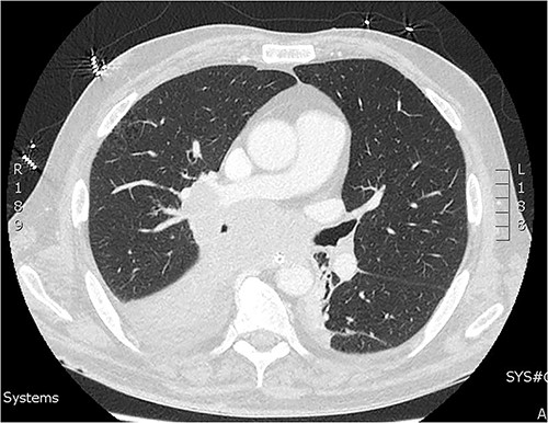 CT of the chest from day two admission demonstrating soft tissue mass enveloping the right bronchi.