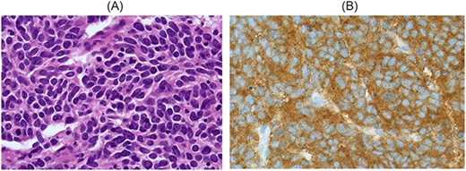 A: A high-power field (60×) demonstrating lesional cells with a small cell morphology. They are round to oval shaped with scant cytoplasm and poorly defined cell borders, with hyperchromatic nuclei and occasional inconspicuous nucleoli. There is nuclear moulding and frequent mitotic figures. B: Immunohistochemistry on tumour cells is positive for synaptophysin, chromogranin A and CD56. Metastatic Merkel cell carcinoma is considered less likely as there is no cytoplasmic CK20 staining. Tumour cells show nuclear staining for TTF1, which is consistent with but nonspecific for metastatic small cell carcinoma of lung.