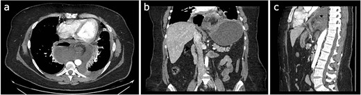 Different sections of the CT study demonstrate the mediastinal position of the gastritis volvulus. (a) Axial CT section of the abdomen showing the stomach body twisted inside the mediastinum. A hydro air level is seen at the right of the stomach body. (b) The coronal CT section of the thorax and the abdomen shows the twisting and dilatation of the reminiscent abdominal portion of the stomach. (c) Sagittal CT section of the thorax and the abdomen showing the posterior mediastinal position of the twisted stomach body.