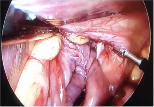 Twisted stomach body protruding through the diaphragmatic pillars, laparoscopic view.