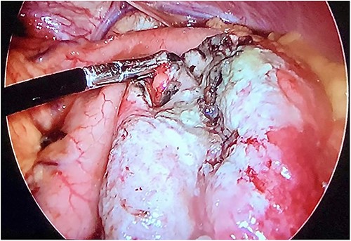 Laparoscopic view demonstrating an approximately 1.5-cm lesion at the level of the greater curvature of the stomach.
