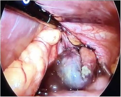 Laparoscopic view of the necrotic hernial sac with food scraps inside.