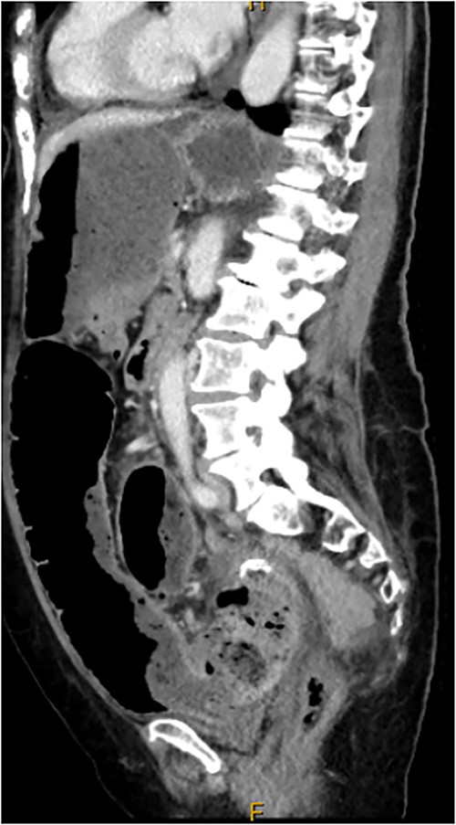 CT scan demonstrating stricture at site of sigmoid anastomosis and proximal dilatation and faecal loading.