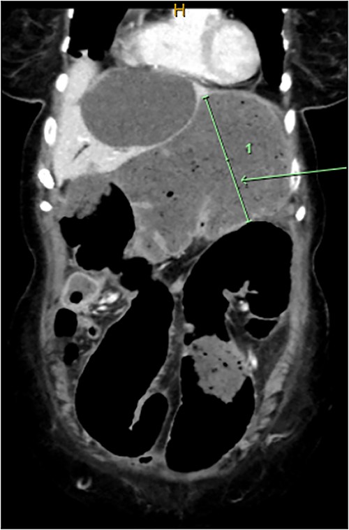 CT scan demonstrating dilatated proximal large bowel and caecum (arrow).