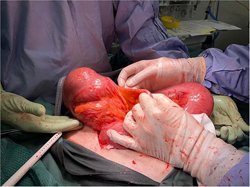 Intra-operative findings, viable but severely dilated caecum and proximal colon.