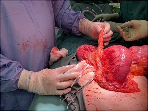 Intra-operative findings, viable but severely dilated caecum and proximal colon.