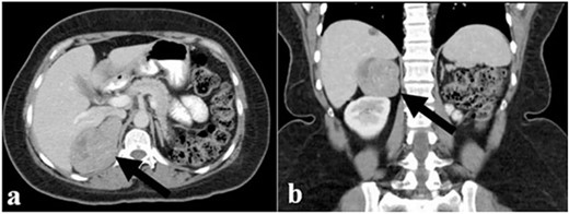 (a) and (b) The abdominal CT scan showed a large right adrenal tumor.