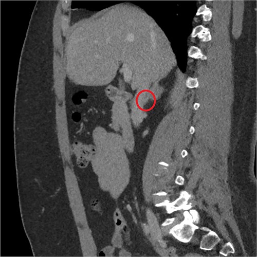 Sagittal 3D reconstruction of CT scan in venous phase. In particular, the images had raised the suspicion of the short course of the adrenal vein in the lower lateral lip of the mass.