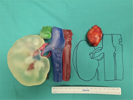 Our 3D anatomic model printed in 1:1 size with the large adrenal tumor removed.