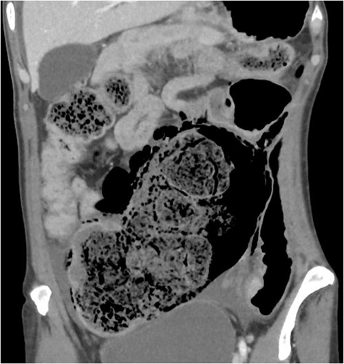 CT abdomen pelvis demonstrating inspissated with faecaloma with pneumatosis and adjacent free gas.