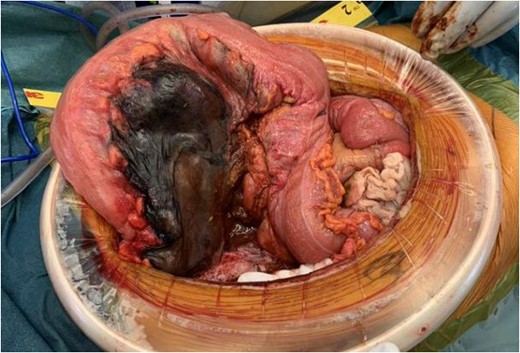 Intraoperative findings of ischaemic stercoral perforation of the sigmoid colon.