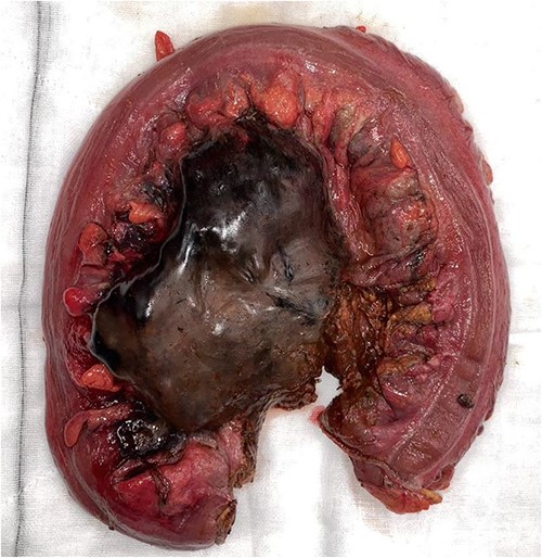Resected specimen demonstrating ischaemic necrosis and faecaloma through large stercoral perforation.