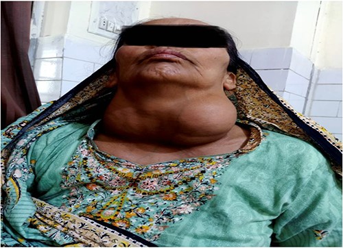 Preoperative picture showing the gross presentation of neck mass occupying bilateral cervical area with more bulk in left cervical region.