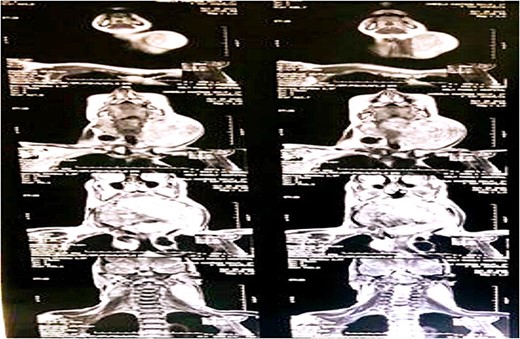CT scan demonstration a well-defined mass in retropharyngeal space measuring 9 × 15 × 11 cm in various dimensions and chunk of calcific foci occupying most of the left retropharyngeal space.