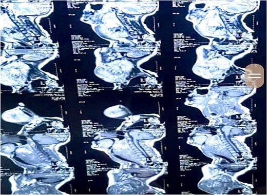 MRI scan demonstration of mass location and extension depicted at various levels of scan measuring 10 × 13.5 × 12.5 cm in size and appearing heterogeneously isointense on T1W1 scan and heterogeneously hyperintense on T1WI and STIR sequence.