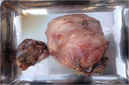 Excised neck mass along with thyroid gland. The larger mass is representative of Liposarcoma and smaller one is thyroid gland.