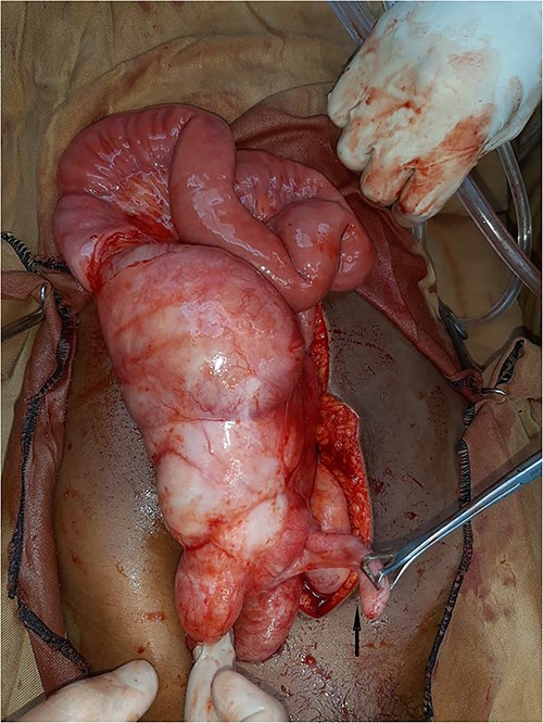 Intra-operative view: most of the small bowel was encapsulated within thickened white, fibrous cocoon like membrane including the distal half of jejunum, ileum and cecum. The appendix was not included within the membrane and congested (black arrow).
