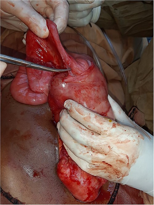 Intra-operative view: starting sharp dissection for the membrane and the small bowel dense adhesions.
