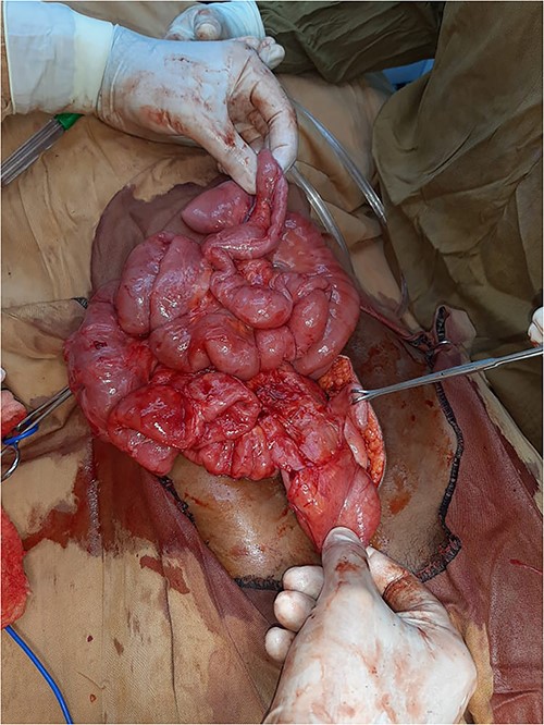 Intra-operative view: complete membrane resection with full small intestine adhesiolysis.
