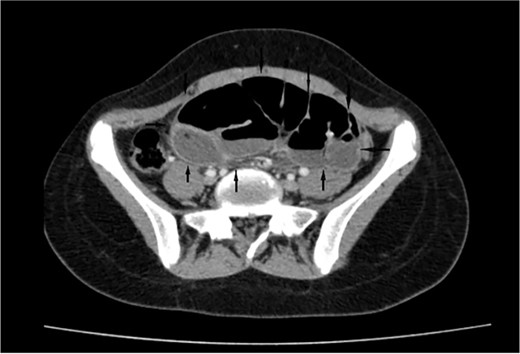 Retrospective review of ECT (axial section), a membrane encapsulates the small intestine centrally indicates the diagnosis of ACS (black arrows).