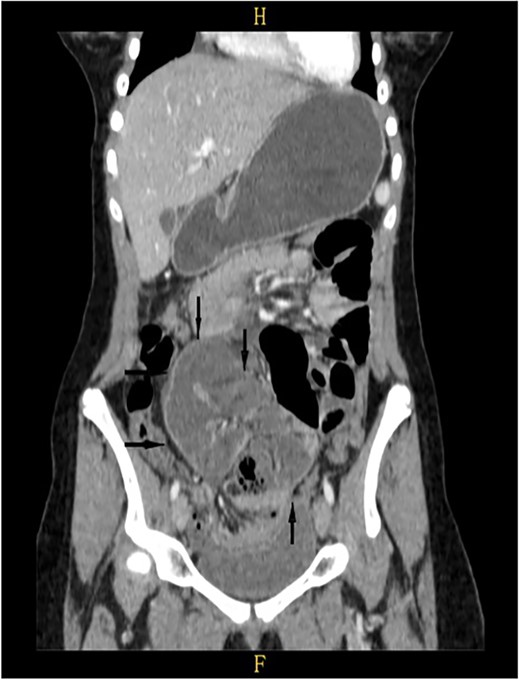 Retrospective review of ECT (coronal section), a membrane encapsulates the small intestine centrally indicates the diagnosis of ACS (black arrows).