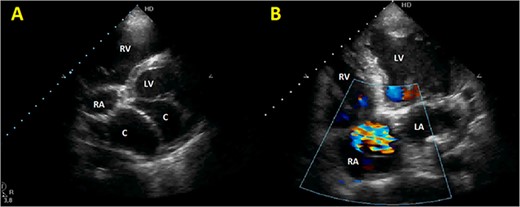 Initial TTE. (A) Parasternal short-axis view showing a bi-atrial cystic lesion; (B) apical 4-chamber view showing color Doppler aliasing in the RA, indicating a shunt. RV, right ventricle; LV, left ventricle; C, cystic lesion.
