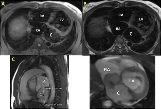 CMR. (A) T1 sequence showing a cystic hypointense lesion, with the same signal than cardiac chambers, located below and behind the LA; (B) T2 sequence showing the hypointense lesion; (C) vertical long axis view showing the bilobed lesion; (D) cine imaging showing an aneurysmal circumflex artery with a right atrial shunt. RV, right ventricle; LV, left ventricle; C, cystic lesion.