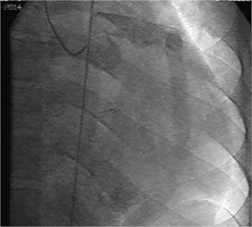CA showing a giant aneurysmal circumflex artery.