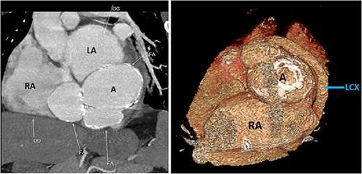 CCTA (with 3D reconstruction) showing the CAF alongside a bilobed saccular aneurysm fed by a giant circumflex artery, next to the RA. A, aneurysm of the circumflex artery; LCX, circumflex artery.