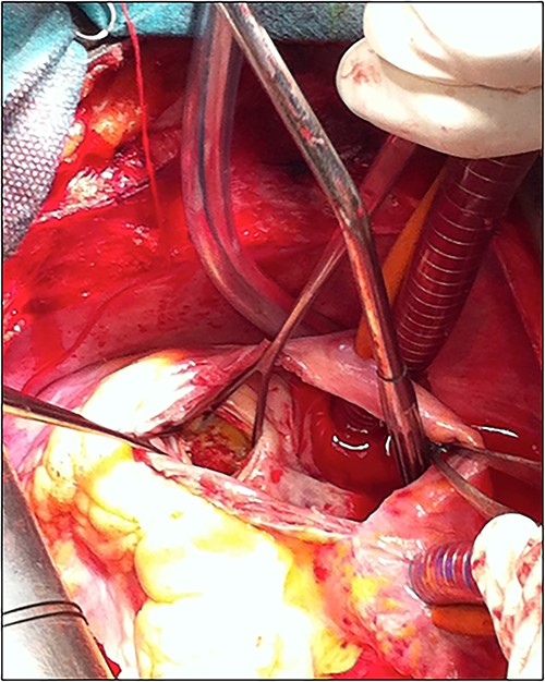 Picture of the surgery showing the patching of the CAF.