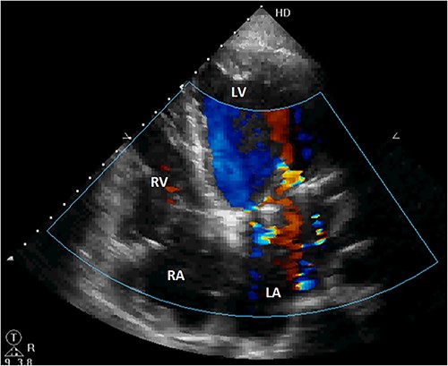 Postoperative TTE showing the disappearance of the right atrial shunt. RV, right ventricle; LV, left ventricle.