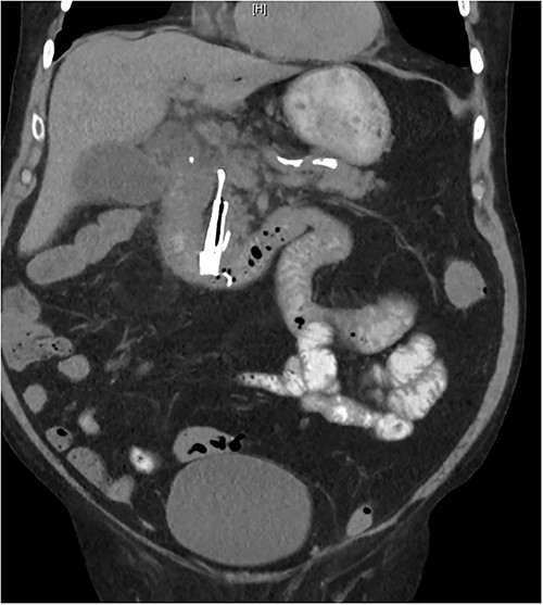 Abdominal CT showing a metallic biliary stent in distal CBD.