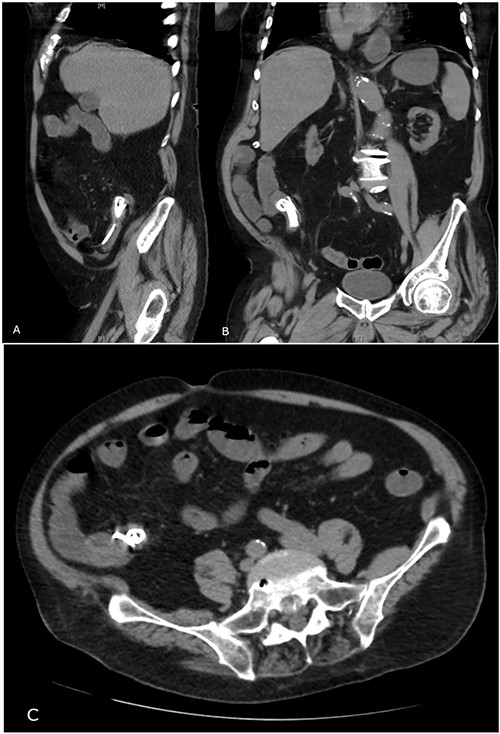 Abdominal CT showing migrated biliary stent in sagittal (A), coronal (B) and transverse (C) views.