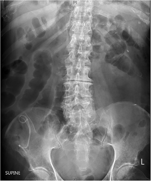 Abdominal radiography showing plastic and metallic biliary stents projected over the right iliac bone and dilated loops of small bowl throughout the abdomen and pelvis.