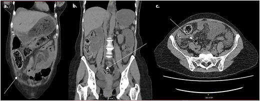 Non-contrast CT scan of the abdomen and pelvis. (a) Axial slice demonstrating transverse colon adhered to structure in right iliac fossa. (b, c) Coronal and axial slices demonstrating sigmoid colon adhered to structure in right iliac fossa.