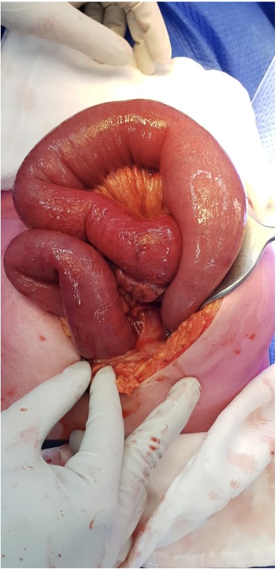 Approximately 50 cm of proximal small bowel involved in closed loop obstruction.