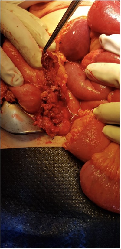 Obliterated appendix with abscess contained pericaecally, after being dissected free.