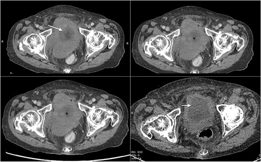 Axial CT scan of abdomen and pelvis with contrast showing mass lesion in the bladder (marked with arrows).