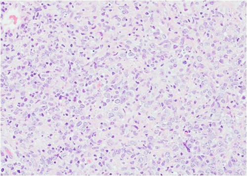 Histopathology image of urinary bladder showing extensive tissue necrosis and presence of tumour in the biopsy with no background normal bladder tissue (stained by H&E, power of magnification at ×200).