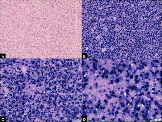 (A) Showing histopathology image of urinary bladder showing extensive tissue necrosis and presence of tumour in the biopsy with no background normal bladder tissue (stained by H&E, power of magnification at ×200); (B, C, D) showing EBV-positive EBER ISH-positive bladder tumour at ×10, ×20 and ×40 power of magnification, respectively.